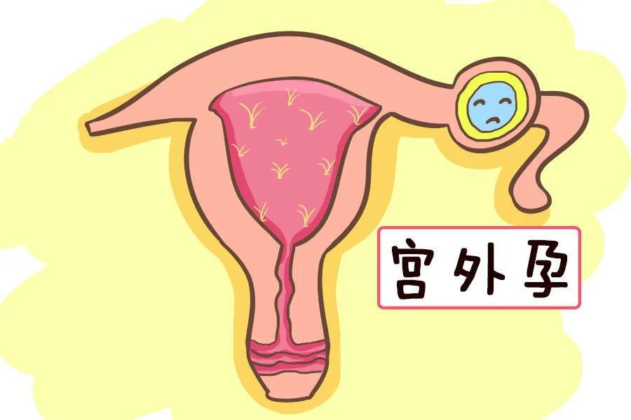 宫外孕七个月,宫外孕七个月，了解、应对与心理调适