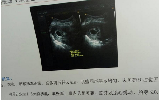 双胞胎两个月b超图,双胞胎两个月B超图，揭示早期生命的神秘面纱