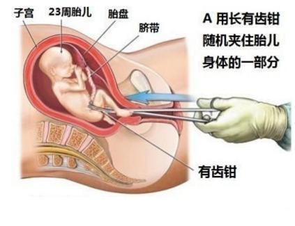 怀孕三个月能做流产么,怀孕三个月能否进行流产，全面解析与关注