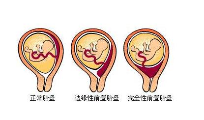 怀孕5个月有点出血,怀孕五个月出血，原因、处理与注意事项